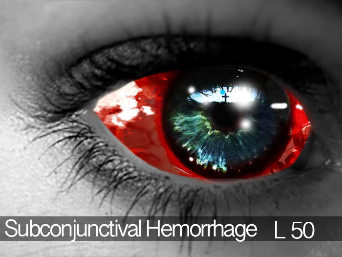Subconjunctival Hemorrhage Mesh Eyes