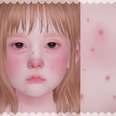 LeMomo: Measles? [Omega]