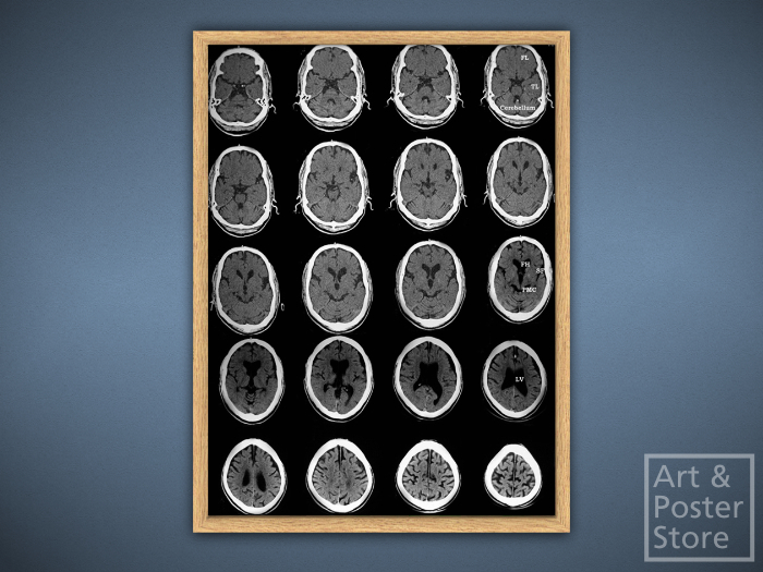 Brain Scan | Photo Poster | Mesh Frame with 6 texture options 